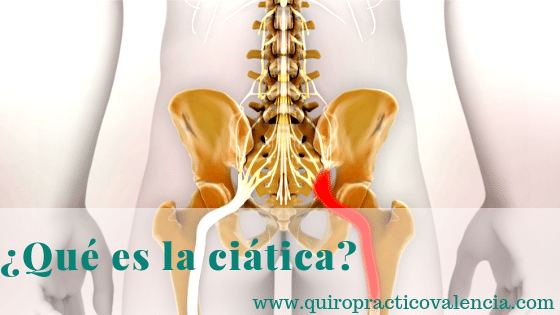 Qué es la ciática
