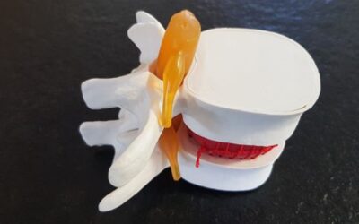 La quiropráctica para mejorar tu hernia discal