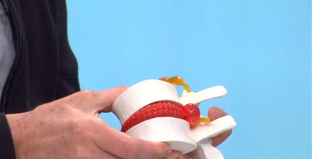 La ciática tiene que ver con vértebras y discos