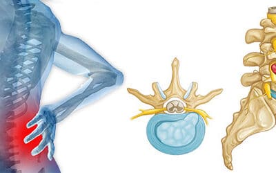 Hernias y la quiropráctica. Causas, síntomas y soluciones.